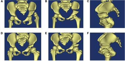 Risk factors for femoral overgrowth after femoral shortening osteotomy in children with developmental dysplasia of the hip